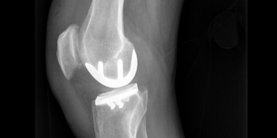 knee