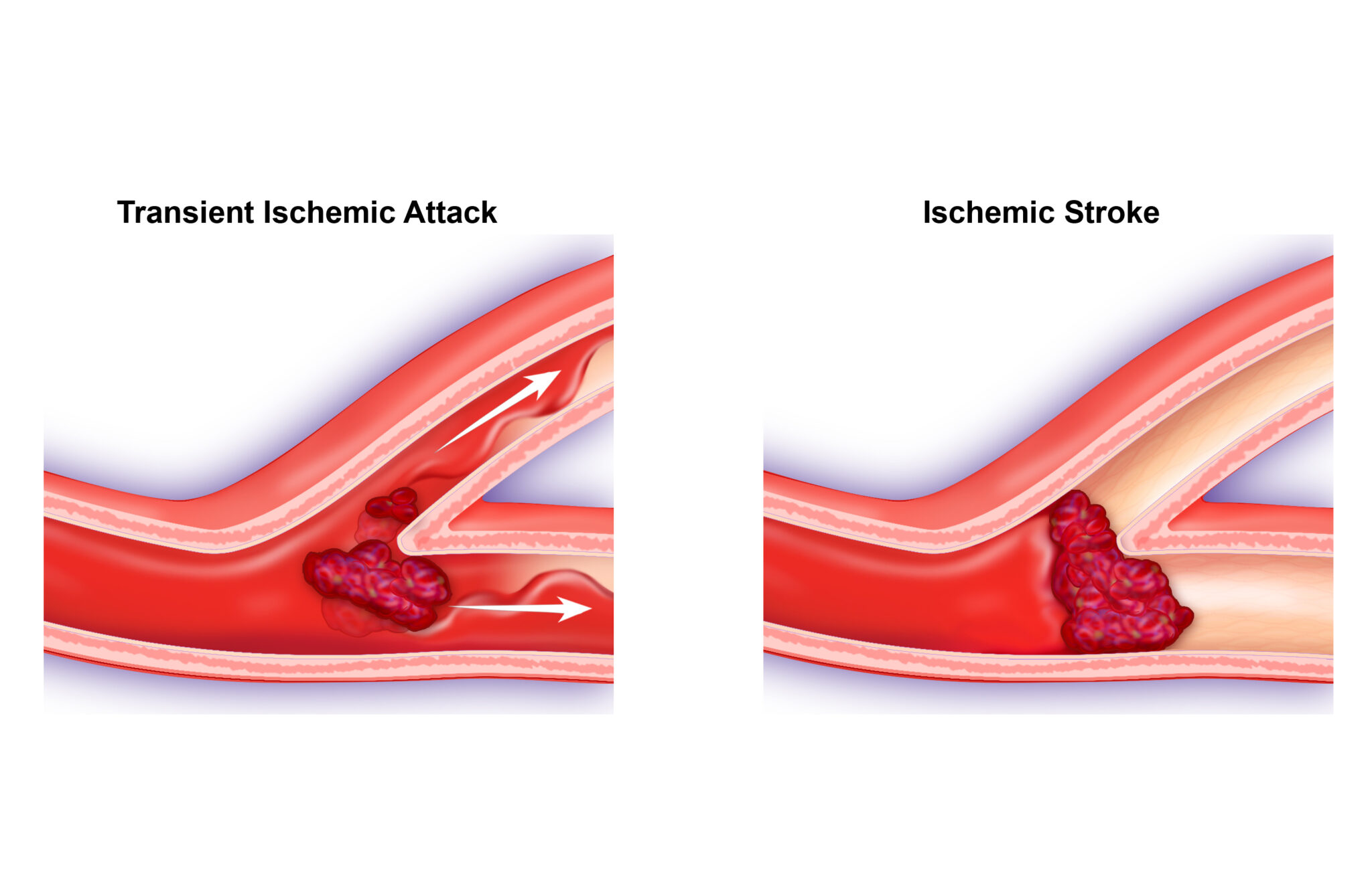 We Talk Health Ep. 157 Let's Talk About Carotid Artery Disease West
