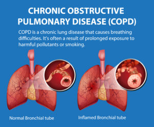 Graphic of Lungs showing COPD