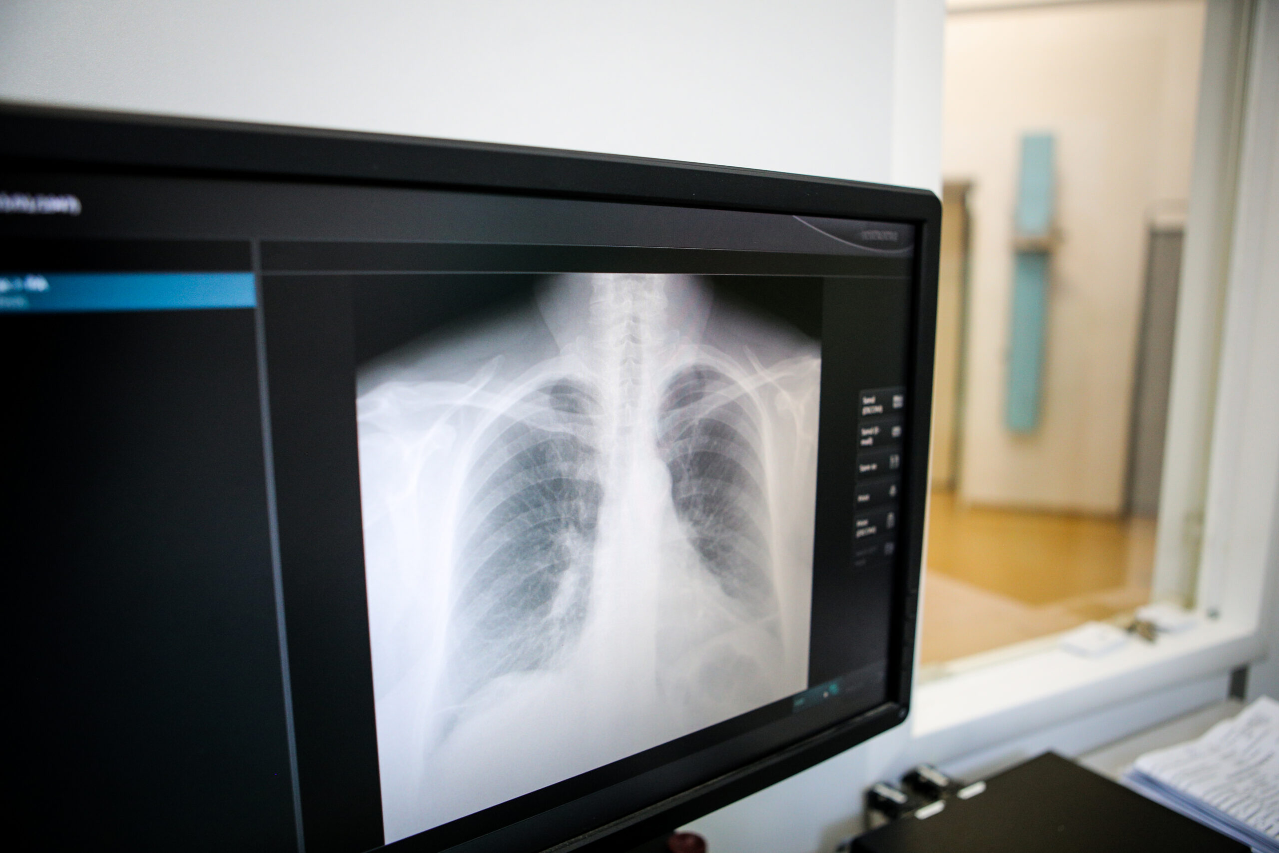 Details with a thoracic X-Ray on a computer monitor inside a