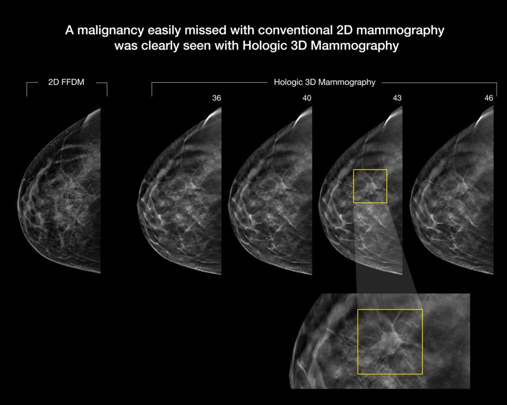 How 3D Mammography Can Help Detect Breast Cancer - West Tennessee ...