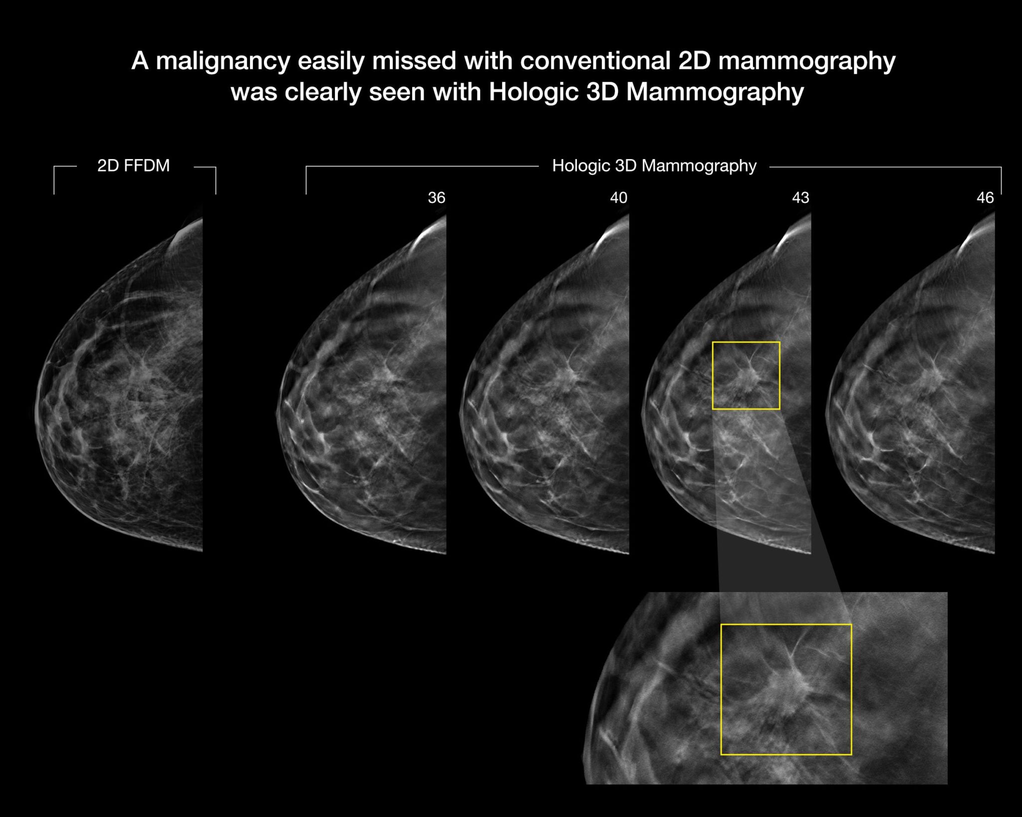 How 3D Mammography Can Help Detect Breast Cancer - West Tennessee ...
